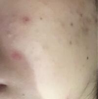 マスクを付け出してからニキビが酷くて 元々ニキビ跡はたくさんあったのですが Yahoo 知恵袋