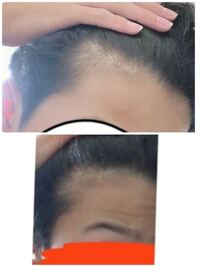 100枚 高三男子です 生え際後退してきてるでしょうか 本当に心配です Yahoo 知恵袋