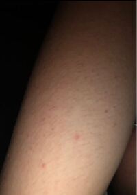 腕のぶつぶつが治りません どういう病気でしょうか Yahoo 知恵袋