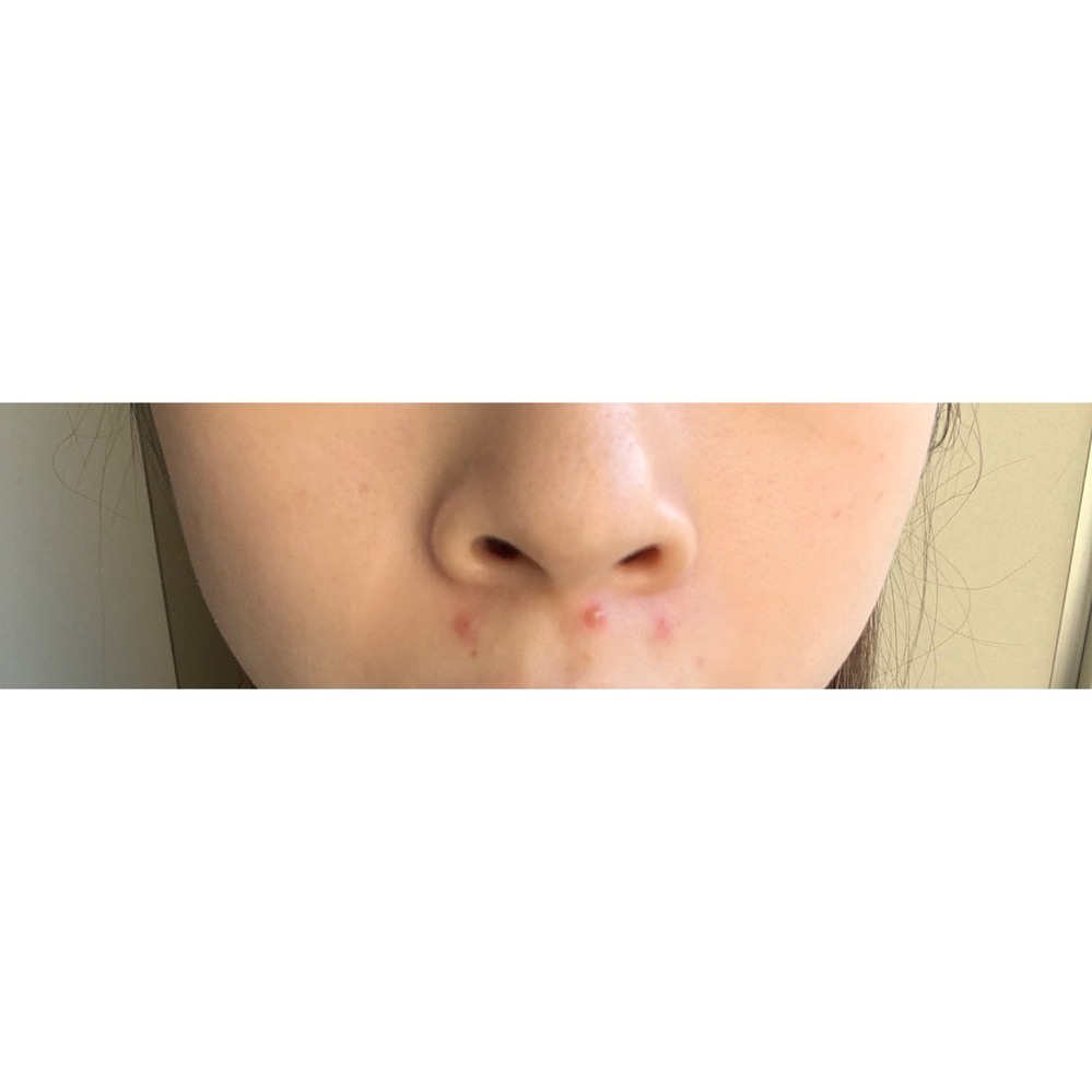 の 占い ニキビ 鼻 下