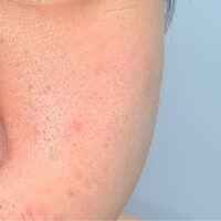 頬にこのような赤みがあります 何が原因ですか Yahoo 知恵袋