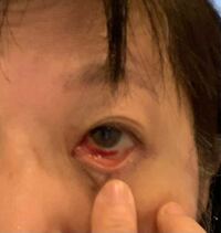 白眼の出血について 白目の出血 硝子体手術 白内障の手術も Yahoo 知恵袋