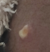 男性器に白いニキビのようなものができてます 場所は包皮の表面です Yahoo 知恵袋