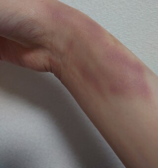 痣を2日で治す方法を探しています 高校生女です 一昨日と今日で2 Yahoo 知恵袋