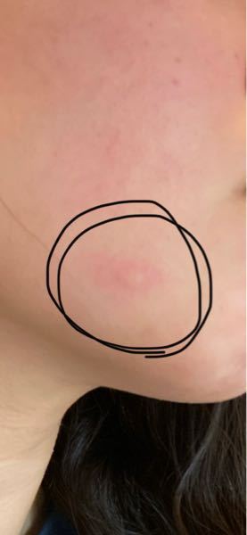 朝起きたときや 気づいたら顔にこのような虫刺されのようなものがで Yahoo 知恵袋
