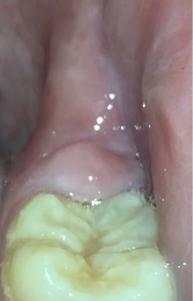 奥歯の歯茎が写真のように膨れて痛いです 昨日から少し痛みと違和感があり見て Yahoo 知恵袋