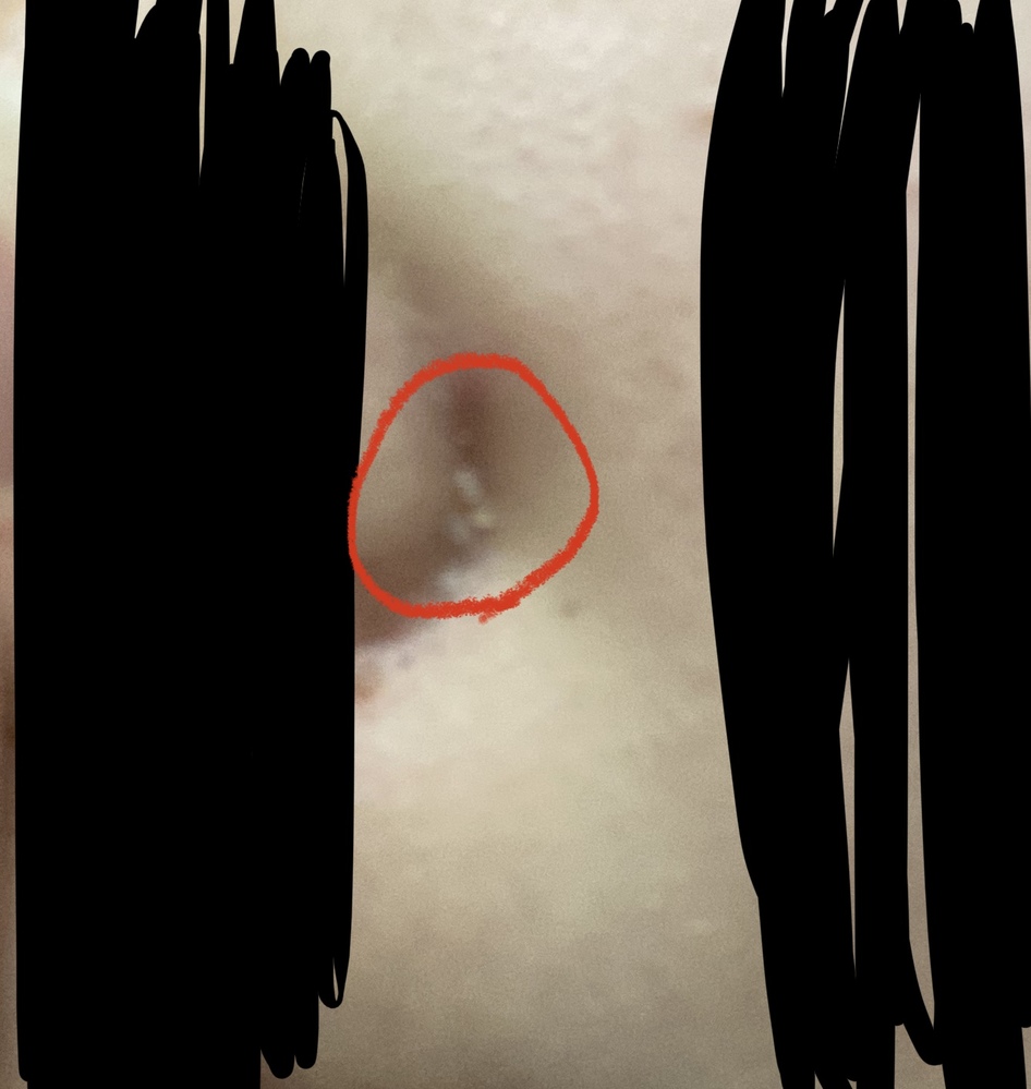 この前鼻の横に白く硬いものがあり多分角質だと思うのですがとったら悪化してし Yahoo 知恵袋