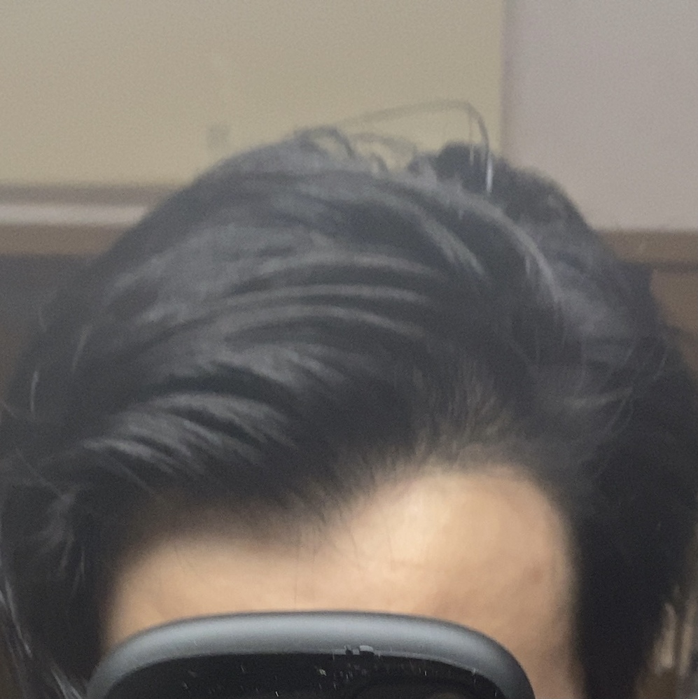 もともと生え際はm字型に近かったのですが最近少し後退した気がしま Yahoo 知恵袋