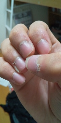 中学２年生です 最近ささくれが多いです 特に親指 この年代 Yahoo 知恵袋