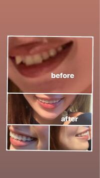 非抜歯の歯科矯正が来月で終了します 先生からまだもう少し歯 Yahoo 知恵袋