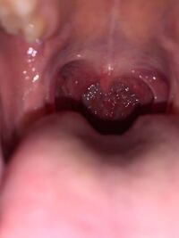 閲覧注意ですこれって喉腫れてますか それほどは腫れていませ Yahoo 知恵袋