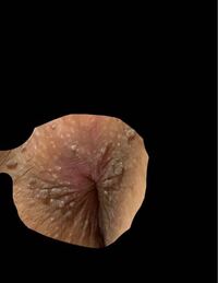 画像注意 肛門の近くにイボのようなものがあるんですが コンジロ Yahoo 知恵袋