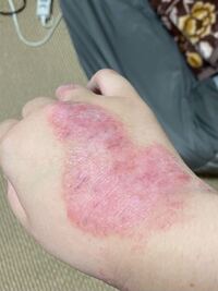 手荒れが酷すぎて治りません 今年初めてこんなことになりました 指 Yahoo 知恵袋