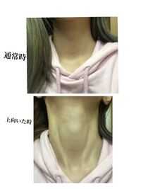 健康診断で甲状腺が腫れてる様に見えると言われ不安で不安で病院に行 Yahoo 知恵袋
