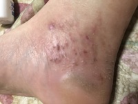 足首の内側に湿疹ができて痒いです太ももに帯状疱疹ができているのですが足首の Yahoo 知恵袋