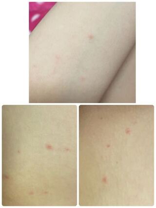 赤い吹き出物 が脚や腕のあちこちにできました 痒くもないし 痛くもありませ Yahoo 知恵袋
