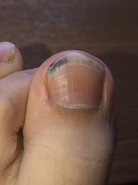 足の爪が黒いことについて 写真あり １ヶ月ほど前から足の爪の Yahoo 知恵袋