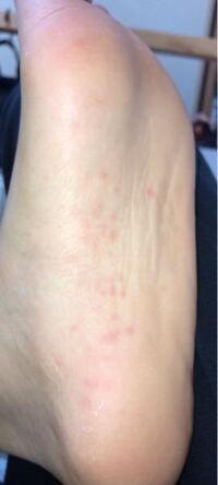 足の裏が一本線で痛いです 今日は陸上の大会で すごく走った Yahoo 知恵袋