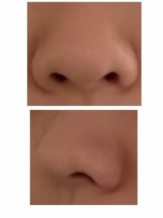 中 もの の 鼻 でき 鼻のできものの悪性の腫瘍や手術の必要性｜ナオール