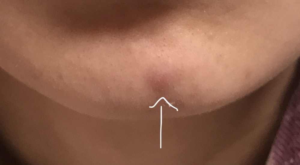 これなんでしょうか ニキビ 吹き出物 のようなよくわからない塊があまり目 Yahoo 知恵袋