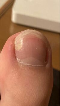 足の親指の爪です これは爪水虫でしょうか かゆみなどはなく 一年 Yahoo 知恵袋