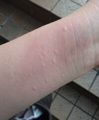 食後や運動後などの誘因なく突然かゆみと発疹がでます 必ず手や腕に Yahoo 知恵袋