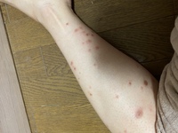 これはダニでしょうか 手足に湿疹ができてとてもかゆいです 最初は足に Yahoo 知恵袋