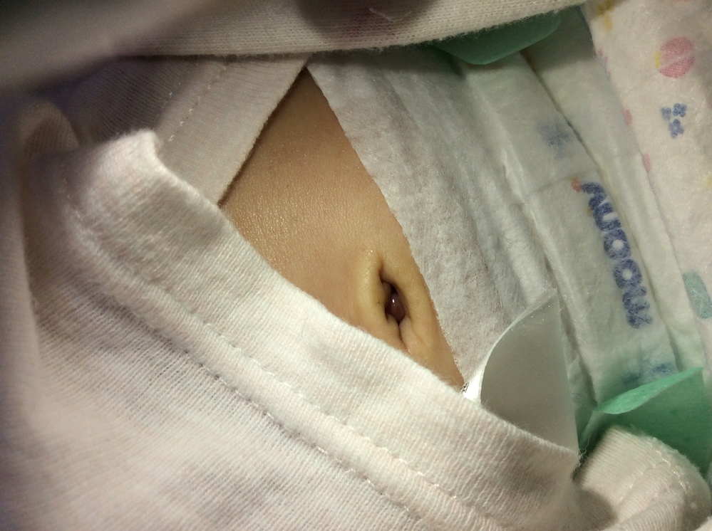 画像あり 臍肉芽腫について生後1ヶ月になる赤ちゃんです お臍のなか Yahoo 知恵袋