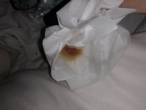 閲覧注意 これは血痰というものでしょうか 先ほど喉に違和感があり オ Yahoo 知恵袋