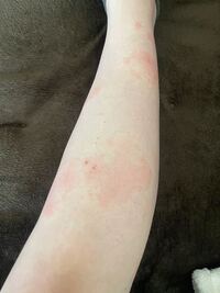 汚い足ですみません 昨日起床すると痒いなと思いみたらこんな風になってま Yahoo 知恵袋