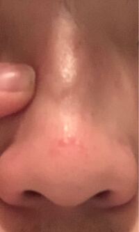 鼻の指で触っているあたりって少しボコって出ているのは普通なんです Yahoo 知恵袋