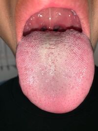 汚い画像すみません 6年前からずっと口臭に悩んでいてベロの舌苔が原因 Yahoo 知恵袋