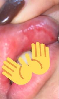 唇の内側が赤くただれていて ひりひりしています 歯茎まで腫れてきまし Yahoo 知恵袋