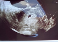昨日5週3日で12 4ミリの胎嚢が確認できました 胎嚢あり Yahoo 知恵袋