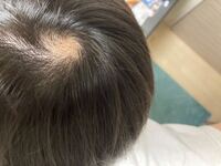 中3の抜毛症です 受験生で親からのプレッシャーが強くて Yahoo 知恵袋