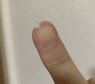 爪の内側の一部が剥がれる 治し方写真のように 爪に縦筋が入り その先の方だ Yahoo 知恵袋