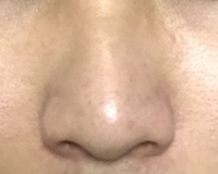 鼻の整形について 私はだんご鼻で かつ横幅が広いのがコンプレックスで Yahoo 知恵袋