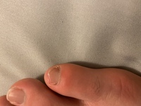 足の小指が腫れてかするだけでも痛いです これはなんですか どうし Yahoo 知恵袋