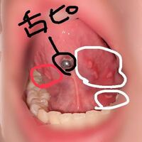 裏 舌 口内炎 原因 の 口腔がんの可能性も？原因ごとに異なる口内炎の種類を知ろう