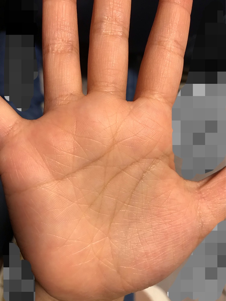 8歳の手相です。生命線が短く心配です。主人も若くして病気で亡くなり