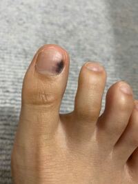 足の爪が1週間程前からこのように黒いです 内出血かなと思いましたが 一向に Yahoo 知恵袋
