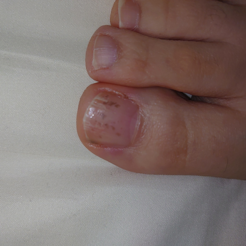 水虫 投票受付中の質問 Yahoo 知恵袋