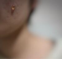 粉瘤 ふんりゅう 表皮嚢腫 ひょうひのうしゅ アテローマ アテローム 粉瘤１ 医療法人恵生会 長瀬内科医院