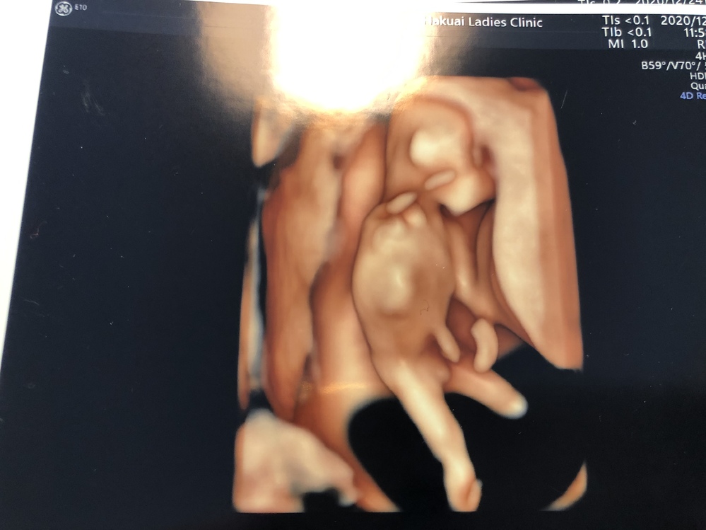 妊娠13週で昨日検診でした エコー写真をもらったのですが これって男の子っ Yahoo 知恵袋