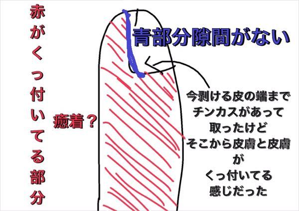 癒着について質問します 僕は中3でちんちんの皮が写真 絵 のよう Yahoo 知恵袋