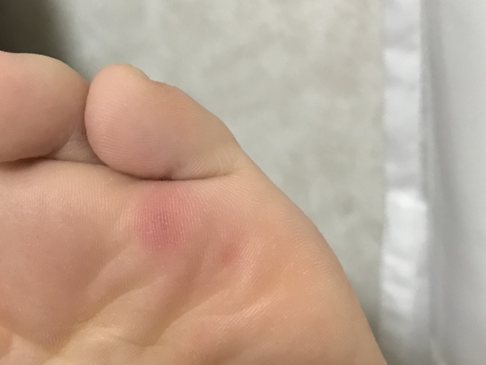 至急 足の裏の画像あります 赤い点は水虫でしょうか 足 Yahoo 知恵袋