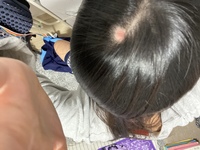 中学二年の女子です頭をかきすぎて傷ができてそこの髪の毛を抜いてしまって毛穴 Yahoo 知恵袋