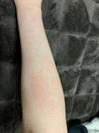 画像あり 脚 腕の痒みのない湿疹について 痒みもなく痛みも無いです Yahoo 知恵袋