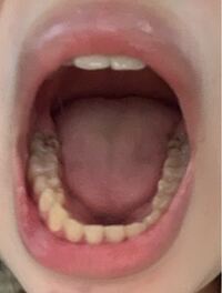 汚くてすみません 奥歯が黒いのですが これは虫歯でしょうか Yahoo 知恵袋