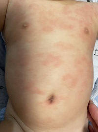 生後5か月で 数日前からお腹に湿疹ができました これは汗疹でしょ Yahoo 知恵袋